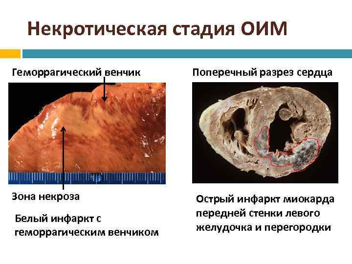 Некротическая стадия ОИМ Геморрагический венчик Зона некроза Белый инфаркт с геморрагическим венчиком Поперечный разрез