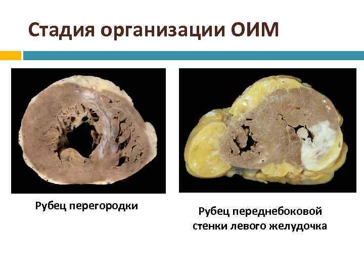 Стадия организации ОИМ Рубец перегородки Рубец переднебоковой стенки левого желудочка 