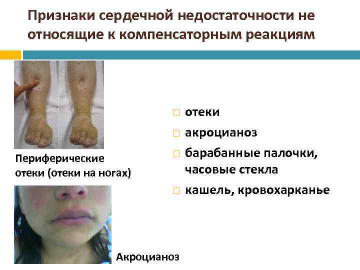 Признаки сердечной недостаточности не относящие к компенсаторным реакциям Периферические отеки (отеки на ногах) Акроцианоз