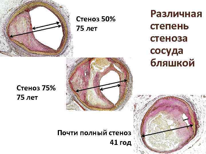 Стеноз 50% 75 лет Стеноз 75% 75 лет Почти полный стеноз 41 год Различная