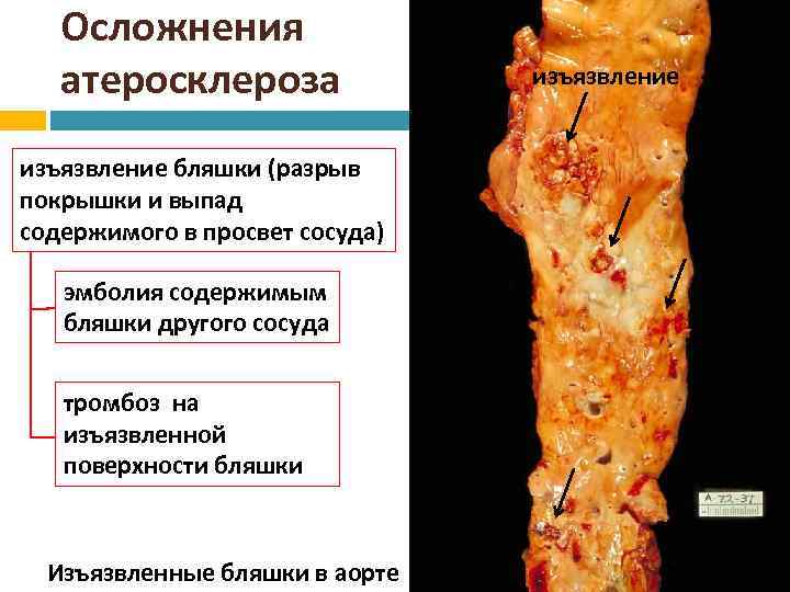 Осложнения атеросклероза изъязвление бляшки (разрыв покрышки и выпад содержимого в просвет сосуда) эмболия содержимым
