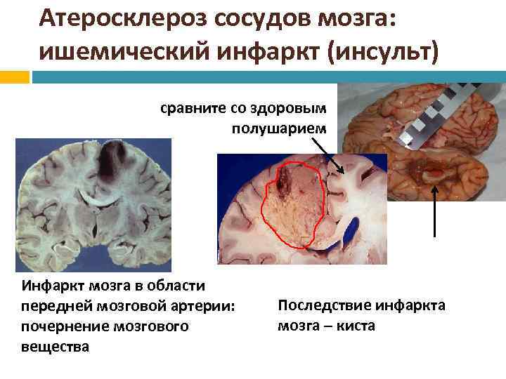 Атеросклероз сосудов мозга: ишемический инфаркт (инсульт) сравните со здоровым полушарием Инфаркт мозга в области