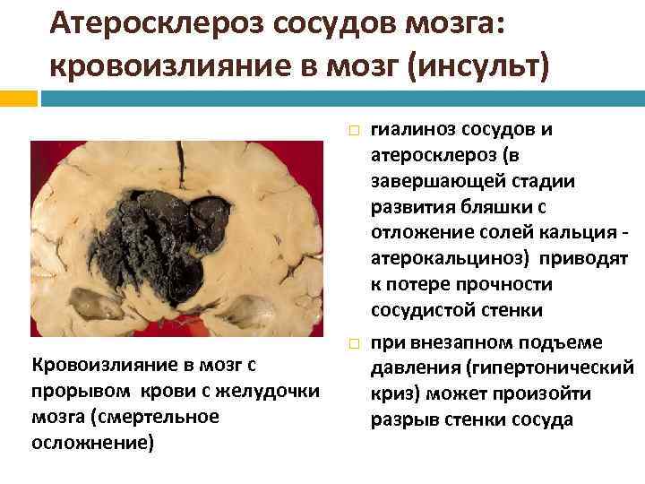 Атеросклероз сосудов мозга: кровоизлияние в мозг (инсульт) Кровоизлияние в мозг с прорывом крови с