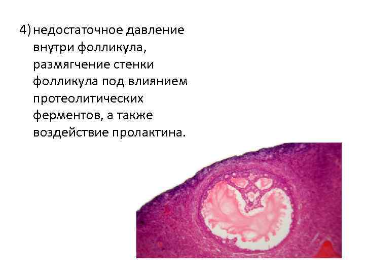 4) недостаточное давление внутри фолликула, размягчение стенки фолликула под влиянием протеолитических ферментов, а также