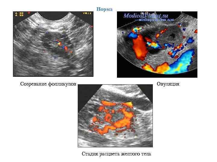 Норма Созревание фолликулов Овуляция Стадия расцвета желтого тела 