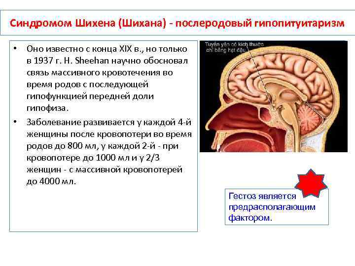 Синдром гипофиза. Послеродовой гипопитуитаризм (синдром Симмондса – Шихена). Послеродовой гипопитуитаризм синдром Шихана патогенез. Патогенез синдрома Шиена. Патогенез синдрома Симмондса-Шихана.