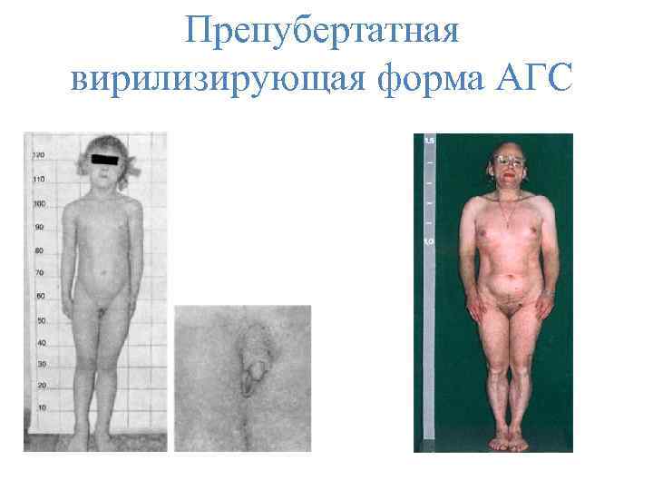 Препубертатная вирилизирующая форма АГС 