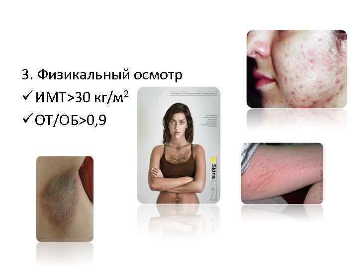 3. Физикальный осмотр ü ИМТ>30 кг/м 2 ü ОТ/ОБ>0, 9 