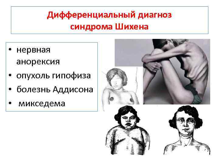 Дифференциальный диагноз синдрома Шихена • нервная анорексия • опухоль гипофиза • болезнь Аддисона •