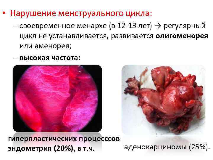  • Нарушение менструального цикла: – своевременное менархе (в 12 13 лет) → регулярный