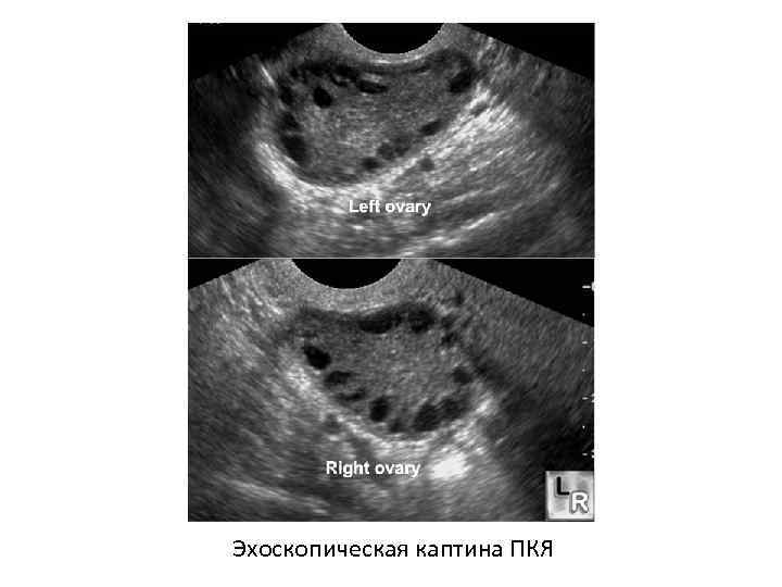 Эхоскопическая каптина ПКЯ 
