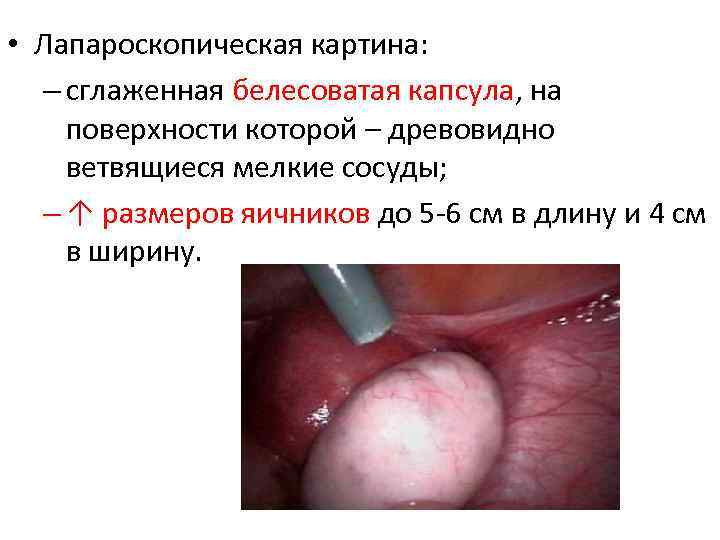  • Лапароскопическая картина: – сглаженная белесоватая капсула, на поверхности которой – древовидно ветвящиеся