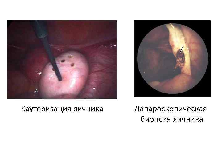 Каутеризация яичника Лапароскопическая биопсия яичника 