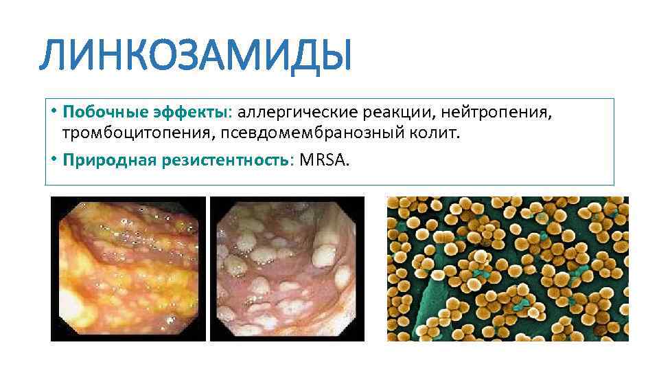 ЛИНКОЗАМИДЫ • Побочные эффекты: аллергические реакции, нейтропения, тромбоцитопения, псевдомембранозный колит. • Природная резистентность: MRSA.