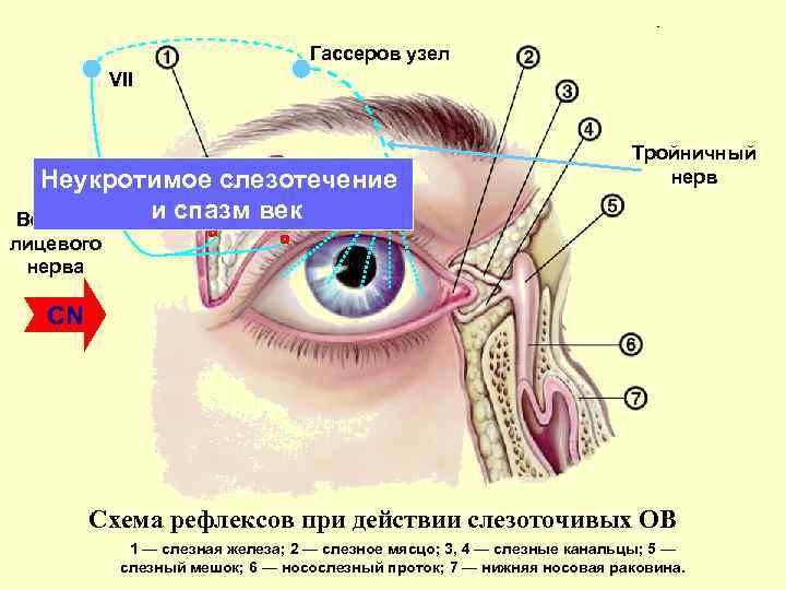 Гассеров узел VII Неукротимое слезотечение и спазм век Волокна Тройничный нерв лицевого нерва CN
