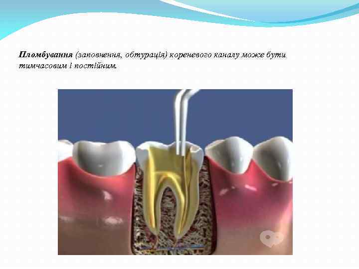 Пломбування (заповнення, обтурація) кореневого каналу може бути тимчасовим і постійним. 