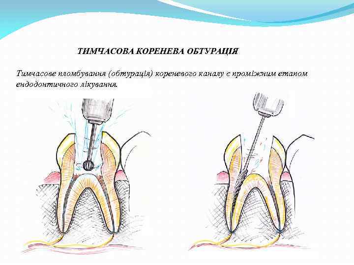 ТИМЧАСОВА КОРЕНЕВА ОБТУРАЦІЯ Тимчасове пломбування (обтурація) кореневого каналу є проміжним етапом ендодонтичного лікування. 