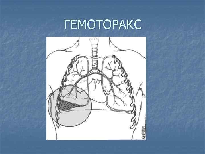 Презентация пневмоторакс и гемоторакс