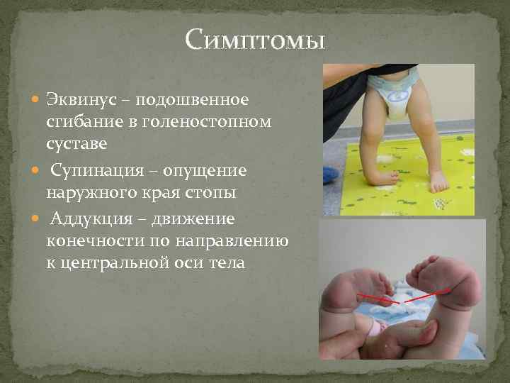 Симптомы Эквинус – подошвенное сгибание в голеностопном суставе Супинация – опущение наружного края стопы