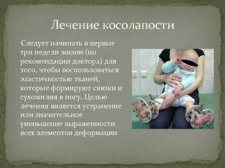 Лечение косолапости Следует начинать в первые три недели жизни (по рекомендации доктора) для того,
