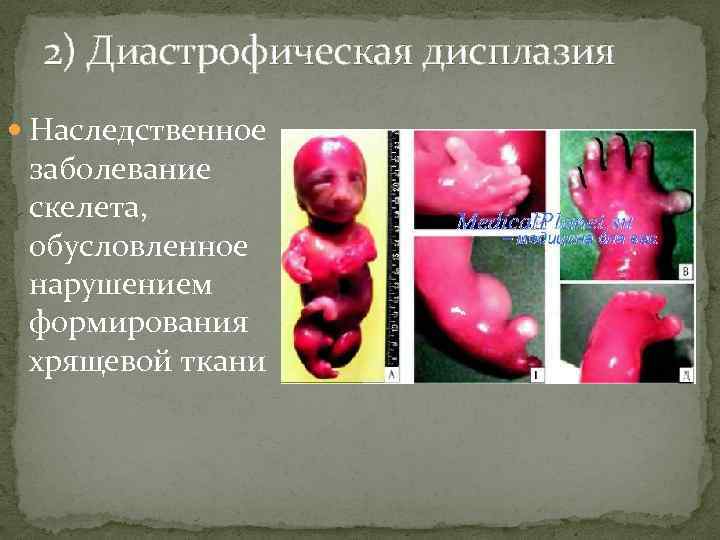 2) Диастрофическая дисплазия Наследственное заболевание скелета, обусловленное нарушением формирования хрящевой ткани 