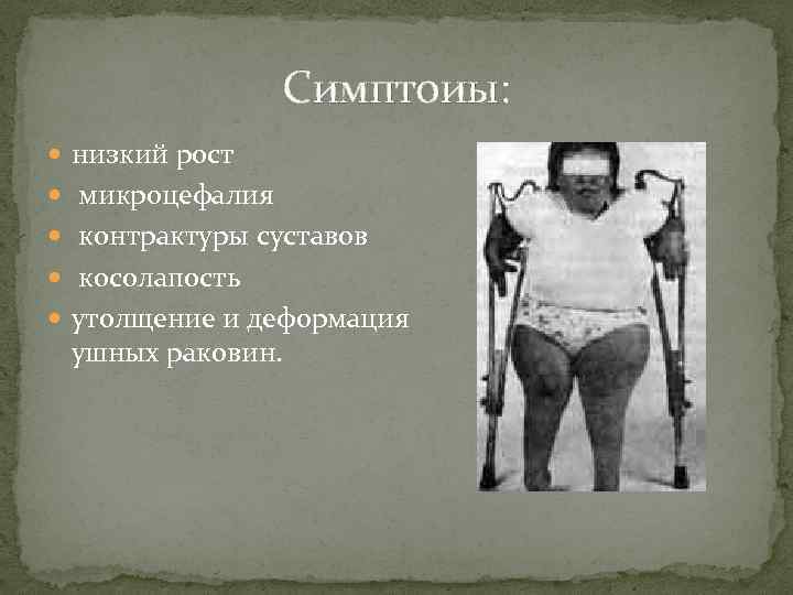Симптоиы: низкий рост микроцефалия контрактуры суставов косолапость утолщение и деформация ушных раковин. 