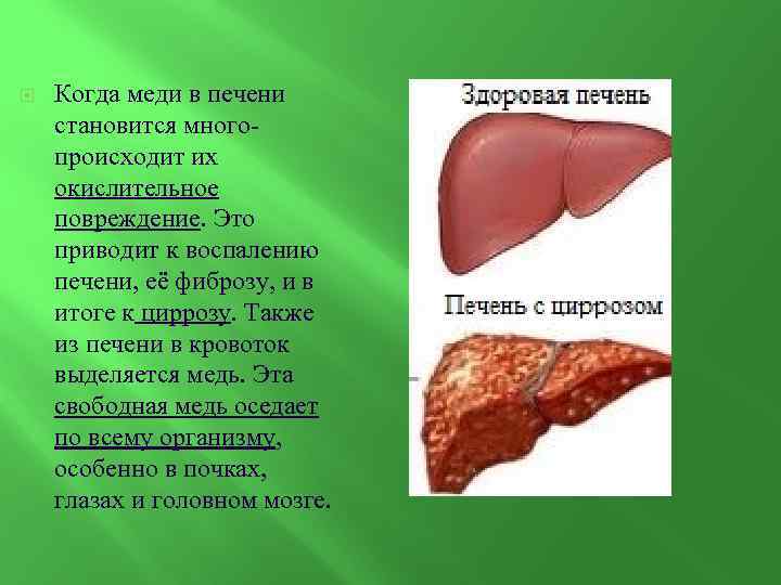  Когда меди в печени становится много- происходит их окислительное повреждение. Это приводит к