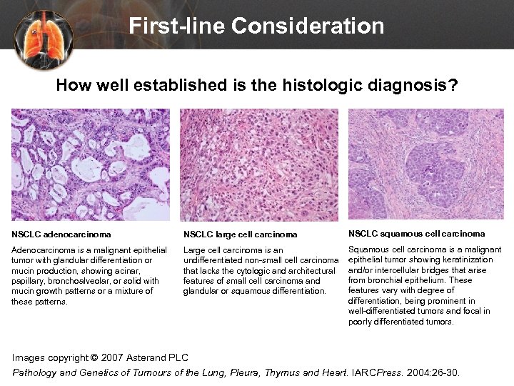 First-line Consideration How well established is the histologic diagnosis? NSCLC adenocarcinoma NSCLC large cell