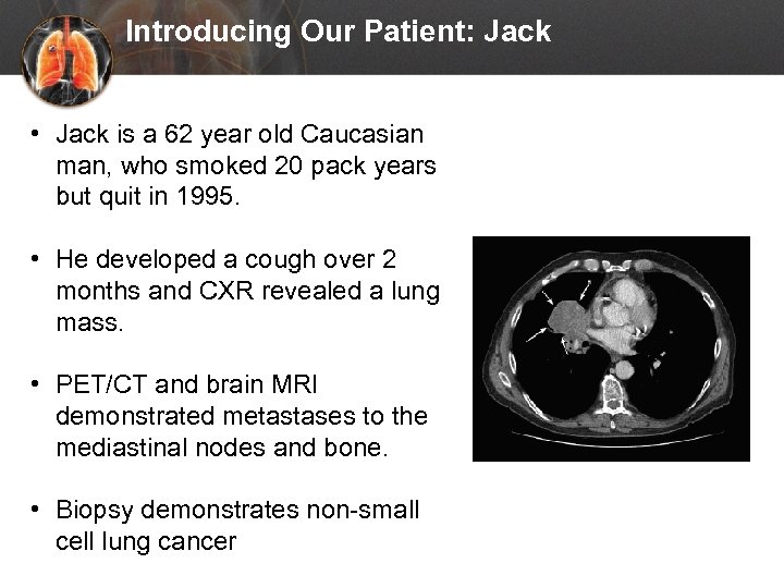 Introducing Our Patient: Jack • Jack is a 62 year old Caucasian man, who