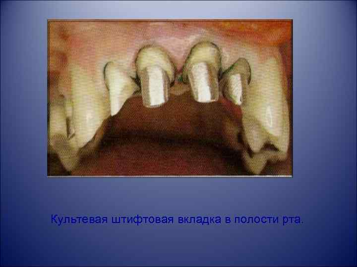 Культевая штифтовая вкладка в полости рта. 