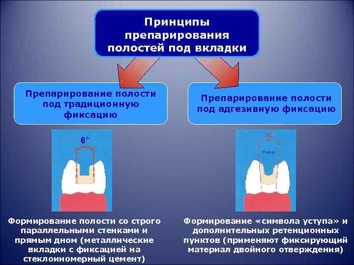 Принципы препарирования полостей под вкладки Препарирование полости под традиционную фиксацию Препарирование полости под адгезивную