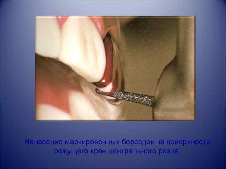 Нанесение маркировочных бороздок на поверхности режущего края центрального резца. 