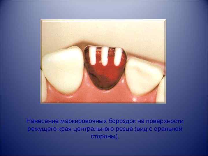 Нанесение маркировочных бороздок на поверхности режущего края центрального резца (вид с оральной стороны). 