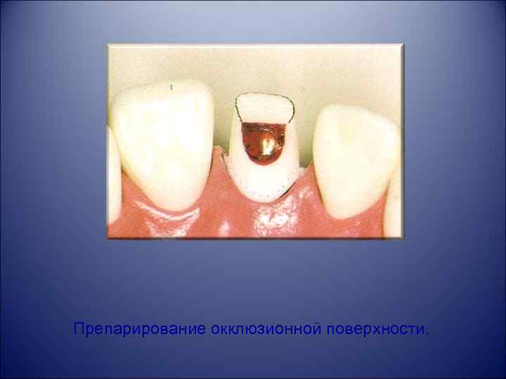 Препарирование окклюзионной поверхности. 