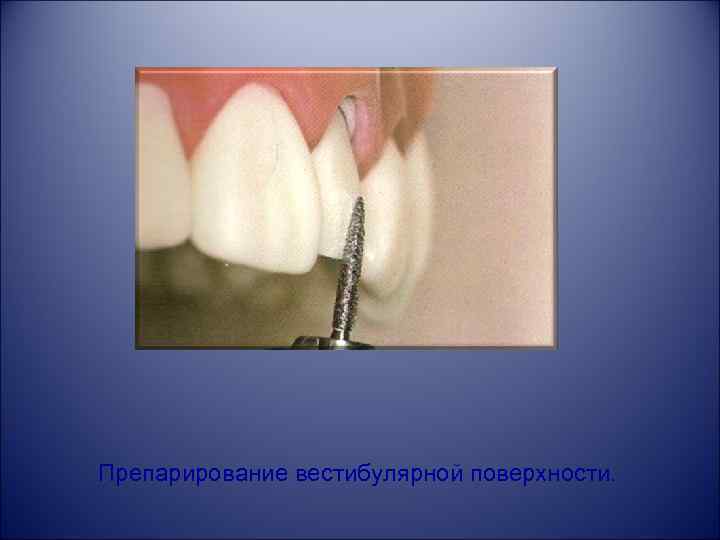 Препарирование вестибулярной поверхности. 