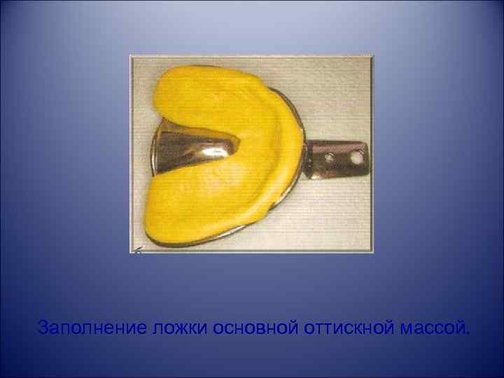 Заполнение ложки основной оттискной массой. 