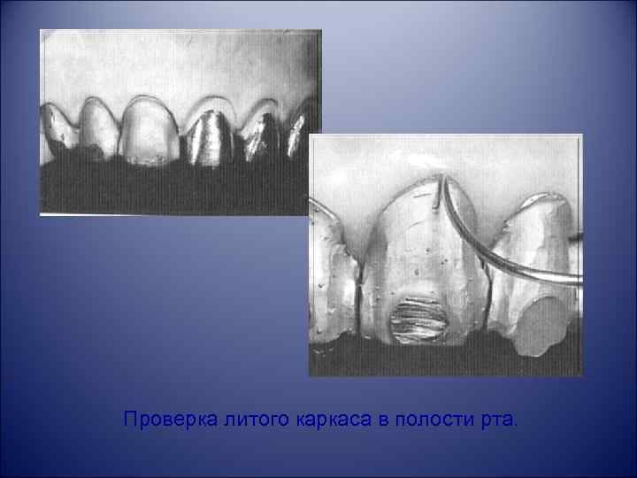 Проверка литого каркаса в полости рта. 