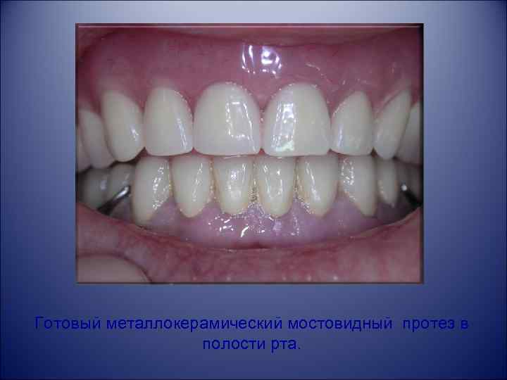 Готовый металлокерамический мостовидный протез в полости рта. 