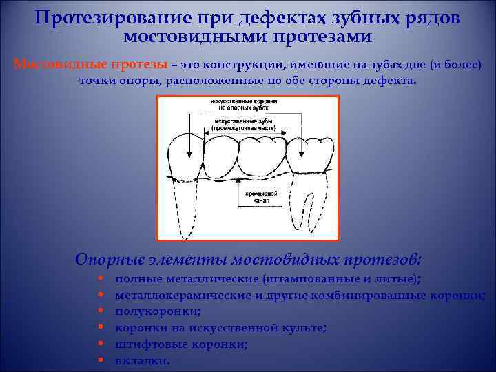 Протезирование при дефектах зубных рядов мостовидными протезами Мостовидные протезы – это конструкции, имеющие на