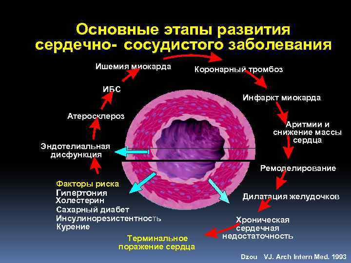Основные этапы развития сердечно- сосудистого заболевания Ишемия миокарда Коронарный тромбоз ИБС Атеросклероз Эндотелиальная дисфункция