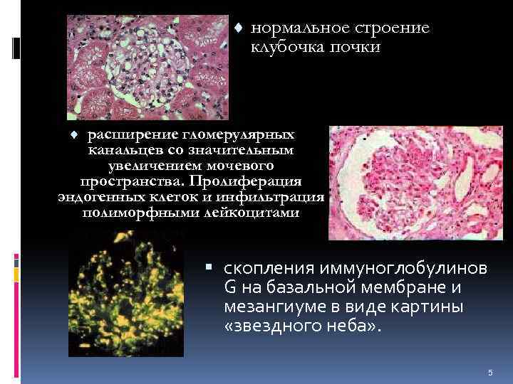 ¨ нормальное строение клубочка почки ¨ расширение гломерулярных канальцев со значительным увеличением мочевого пространства.