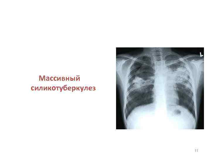 Массивный силикотуберкулез 11 
