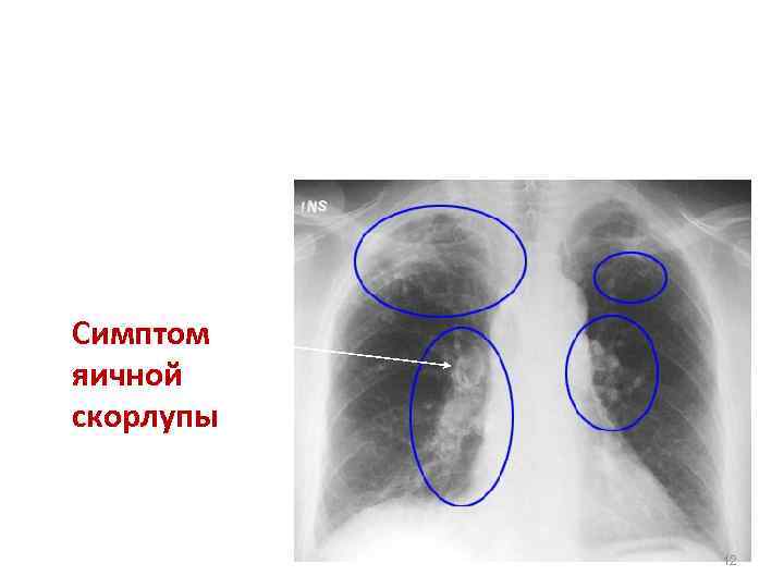Симптом яичной скорлупы 12 