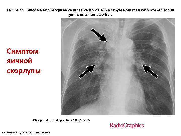 Figure 7 a. Silicosis and progressive massive fibrosis in a 58 -year-old man who