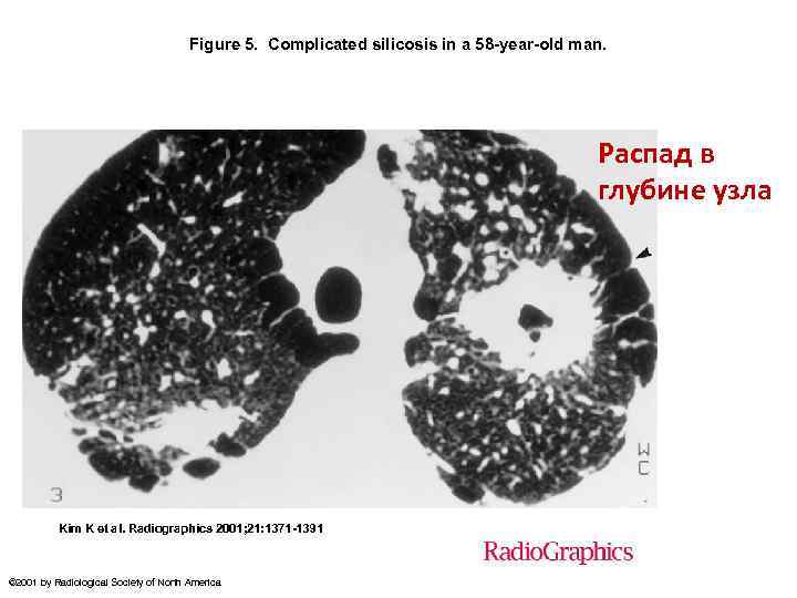 Figure 5. Complicated silicosis in a 58 -year-old man. Распад в глубине узла Kim