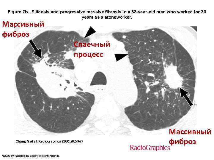 Figure 7 b. Silicosis and progressive massive fibrosis in a 58 -year-old man who