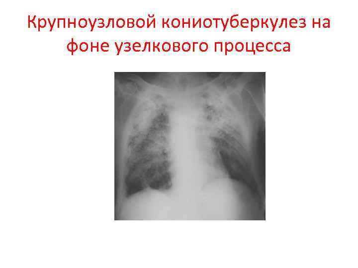 Крупноузловой кониотуберкулез на фоне узелкового процесса 