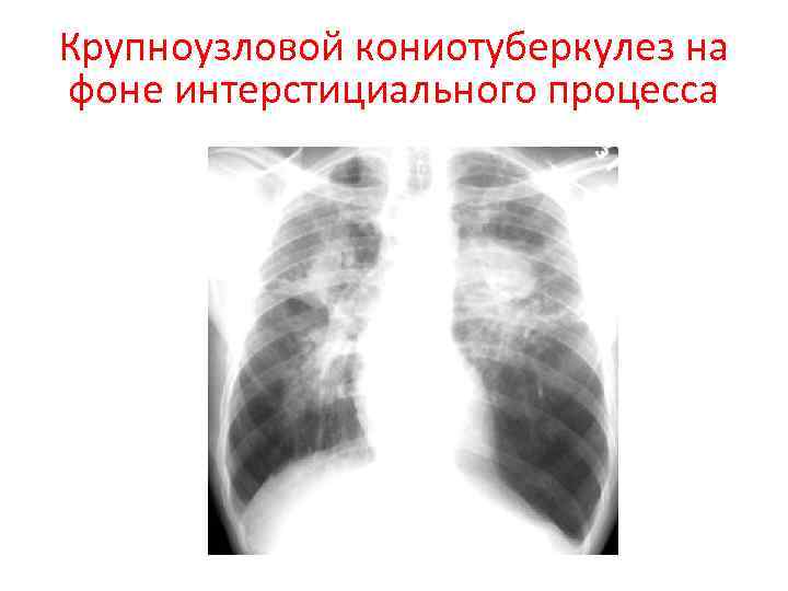 Крупноузловой кониотуберкулез на фоне интерстициального процесса 