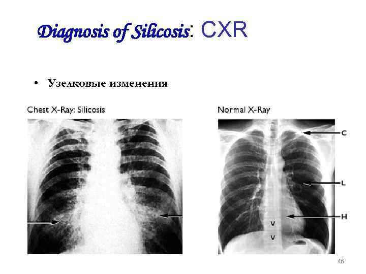 Diagnosis of Silicosis: CXR • Узелковые изменения 46 