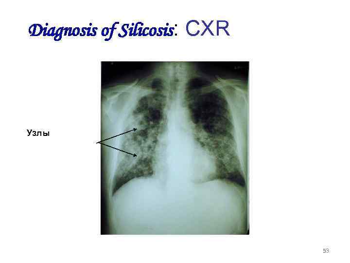 Diagnosis of Silicosis: CXR Узлы 53 